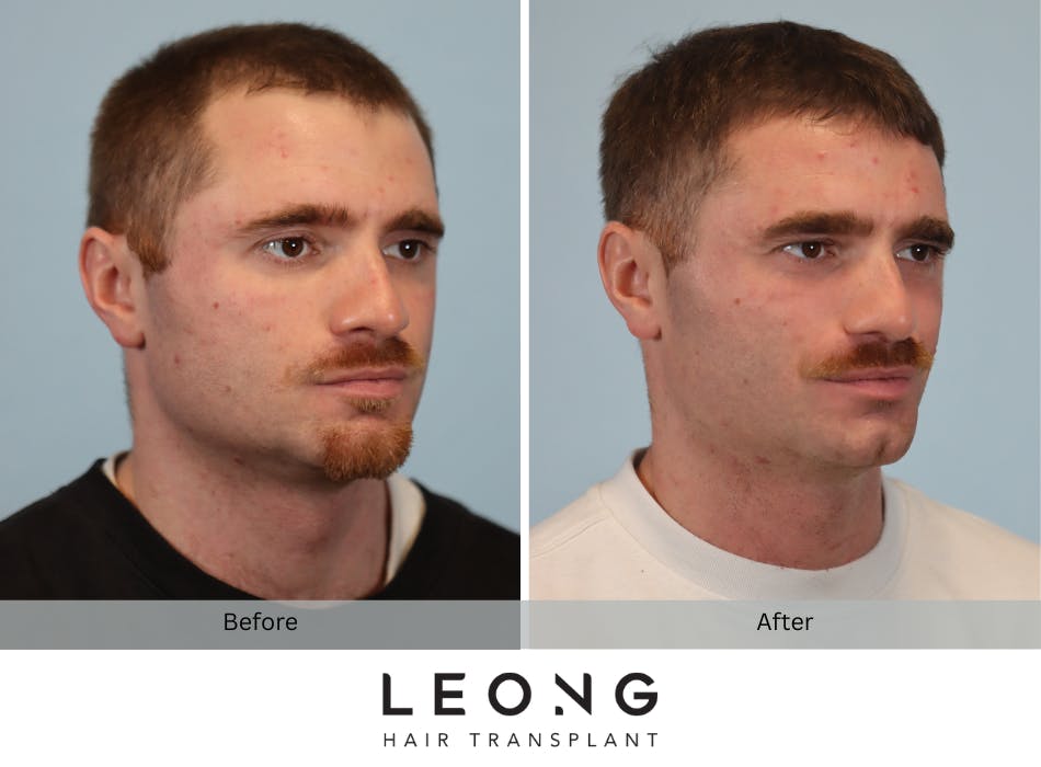 Hair Transplant Before and After | Leong Facial Plastic Surgery