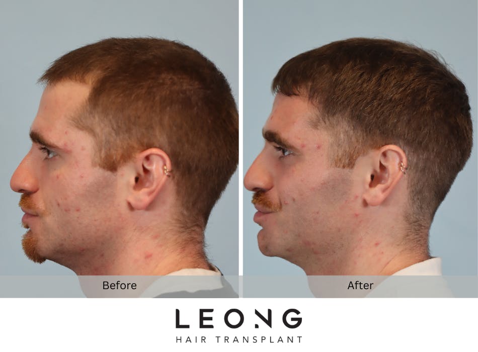 Hair Transplant Before and After | Leong Facial Plastic Surgery
