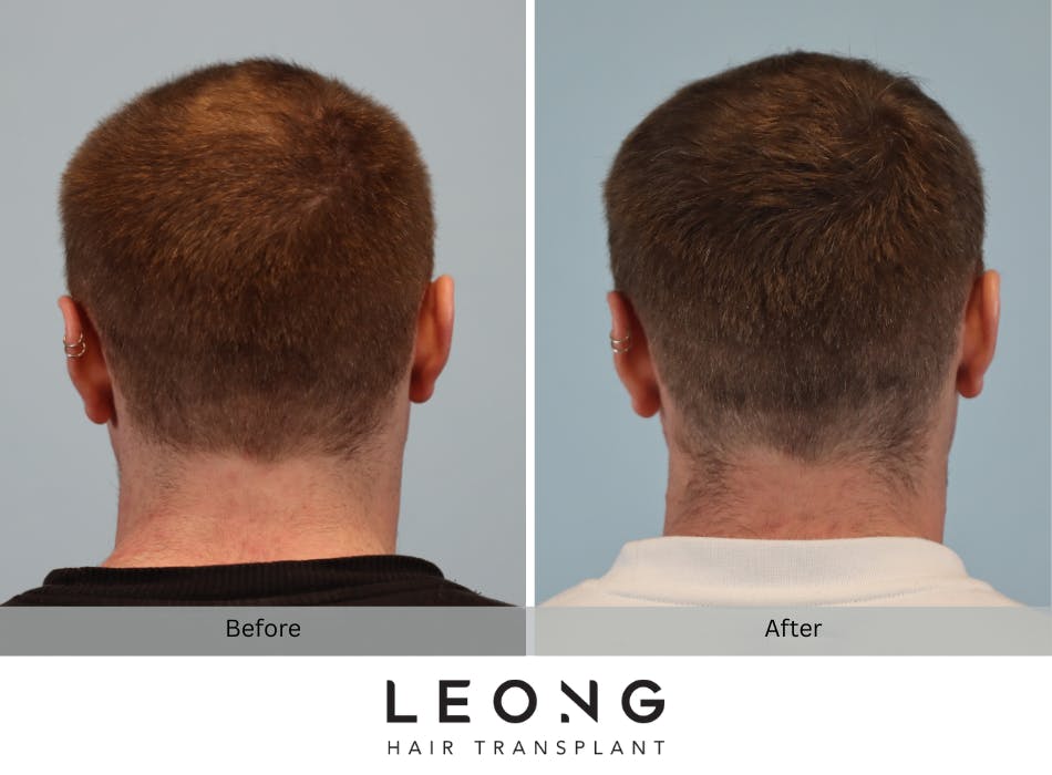 Hair Transplant Before and After | Leong Facial Plastic Surgery
