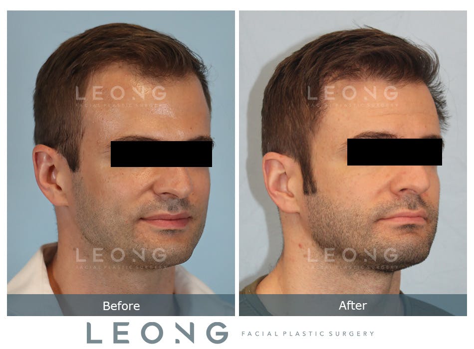 Hair Transplant Before and After | Leong Facial Plastic Surgery
