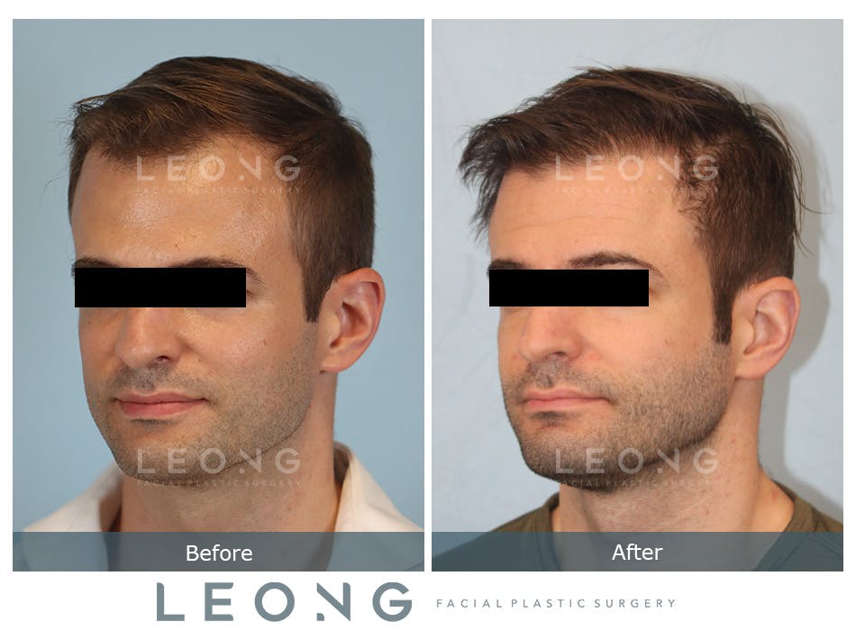 Hair Transplant Before and After | Leong Facial Plastic Surgery
