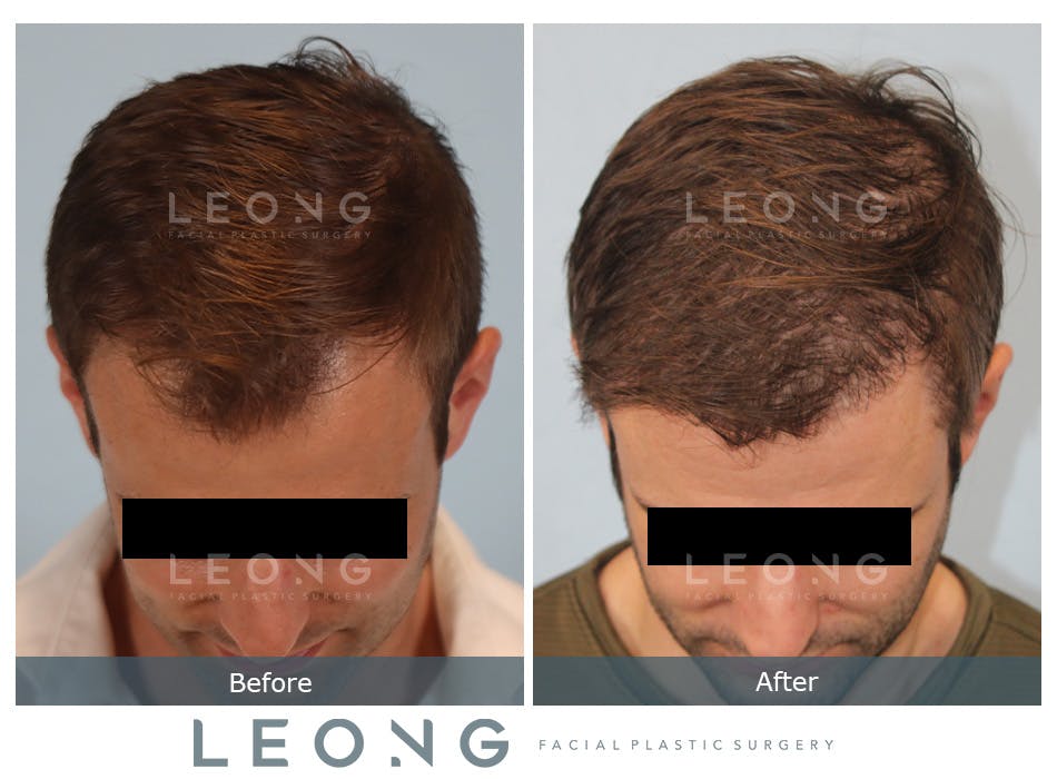 Hair Transplant Before and After | Leong Facial Plastic Surgery