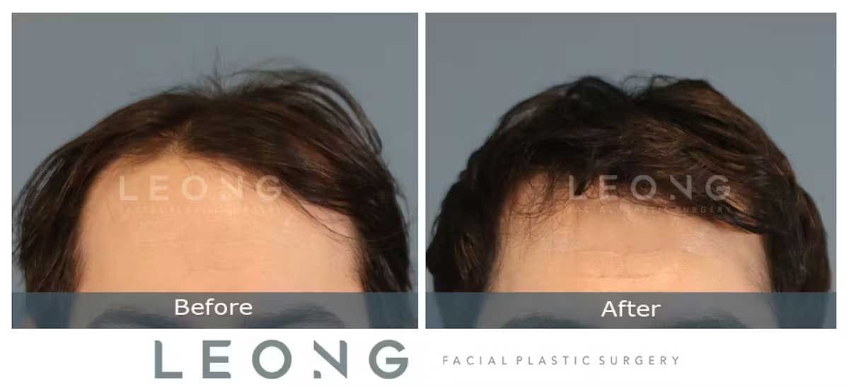 Hair Transplant Before and After | Leong Facial Plastic Surgery