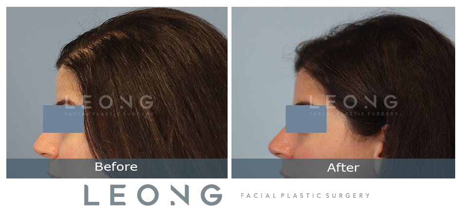 Hair Transplant Before and After | Leong Facial Plastic Surgery