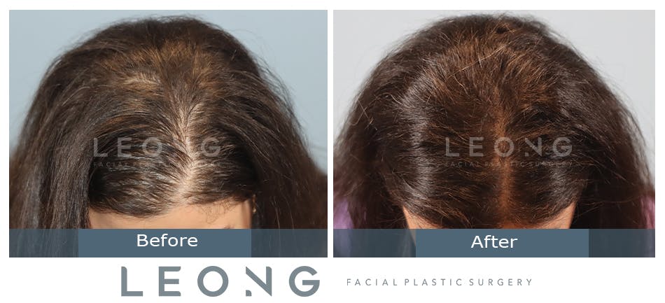 Hair Transplant Before and After | Leong Facial Plastic Surgery