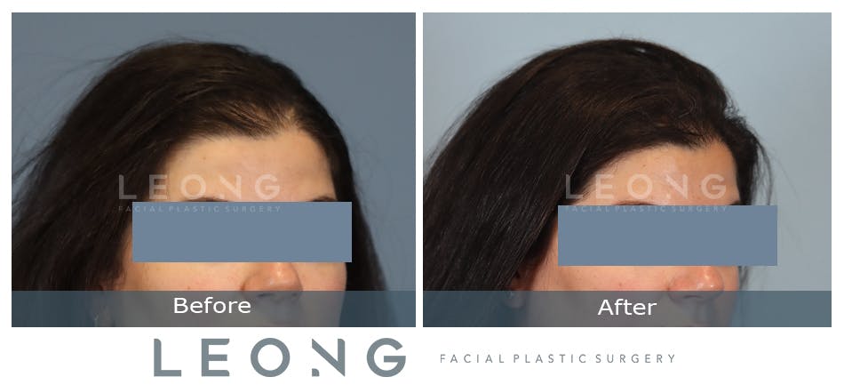 Hair Transplant Before and After | Leong Facial Plastic Surgery