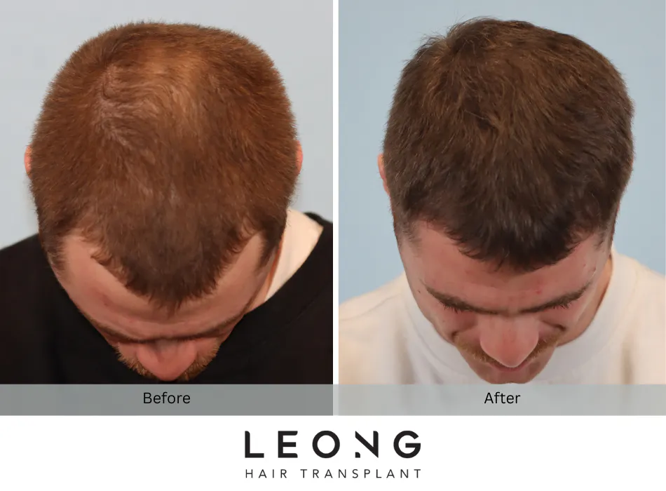 Hair Transplant Before and After | Leong Facial Plastic Surgery