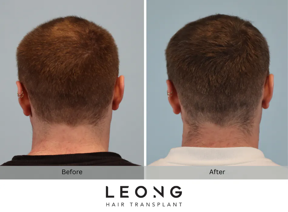 Hair Transplant Before and After | Leong Facial Plastic Surgery