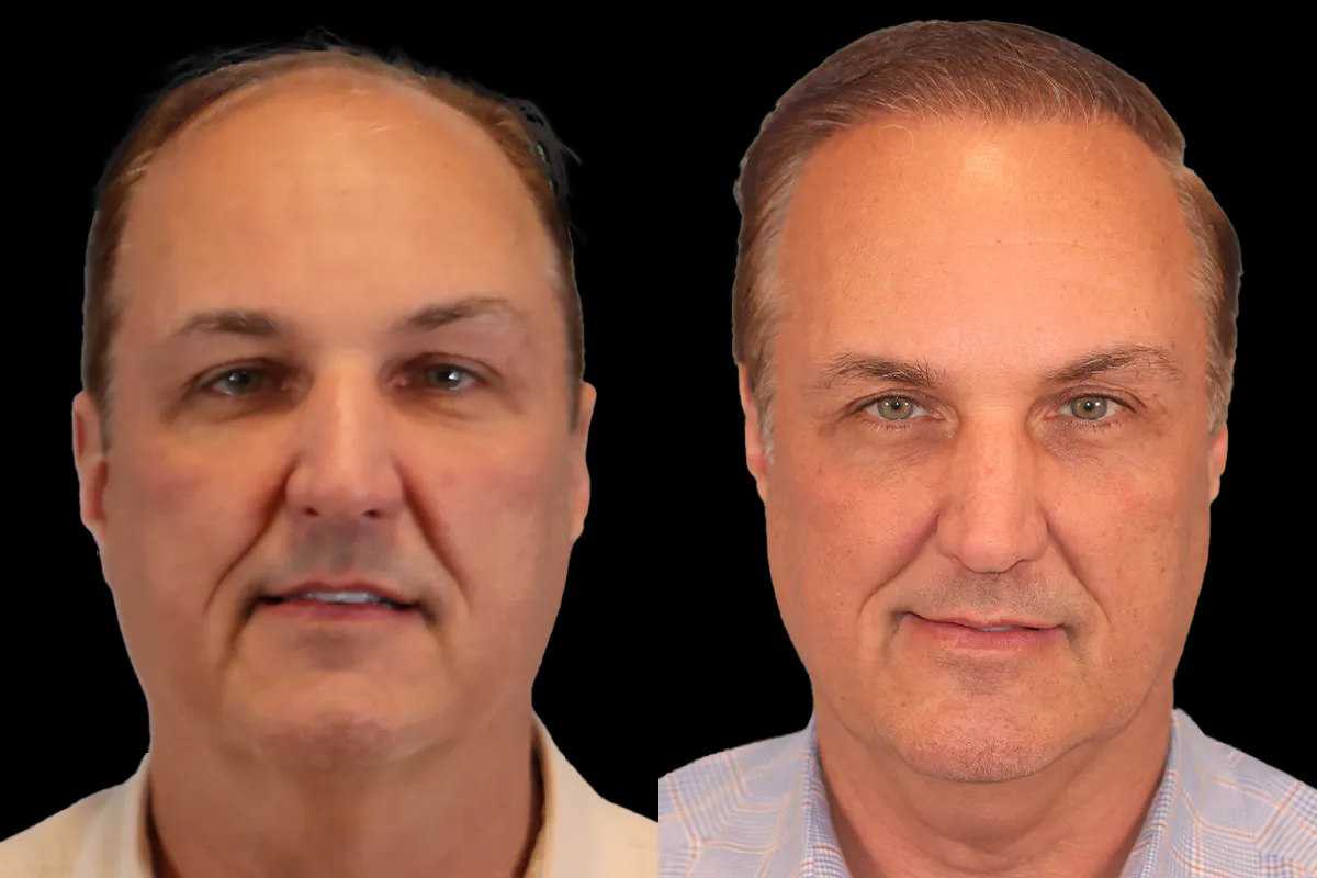 Hair Transplant Before and After | Leong Facial Plastic Surgery