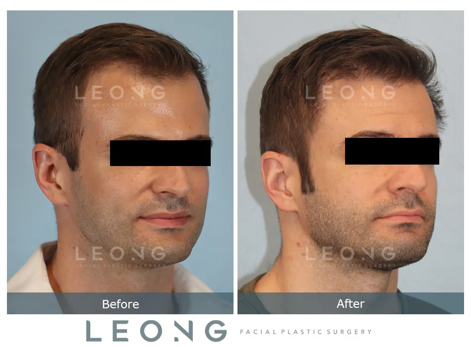 Hair Transplant Before and After | Leong Facial Plastic Surgery