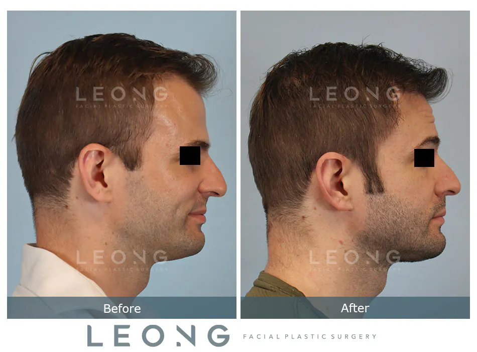 Hair Transplant Before and After | Leong Facial Plastic Surgery