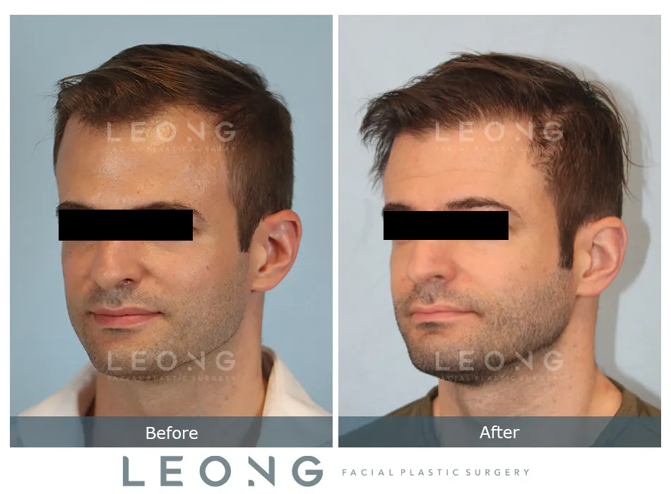 Hair Transplant Before and After | Leong Facial Plastic Surgery