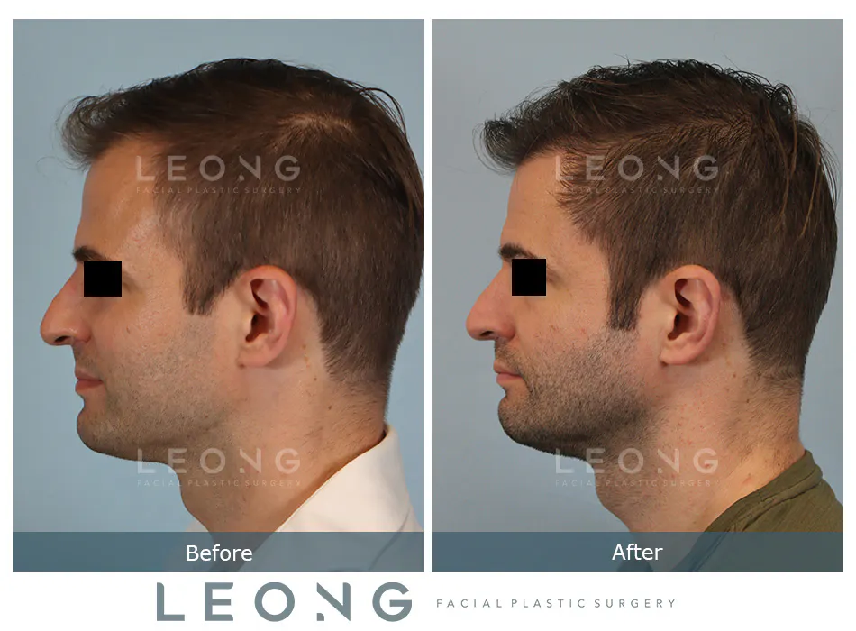 Hair Transplant Before and After | Leong Facial Plastic Surgery