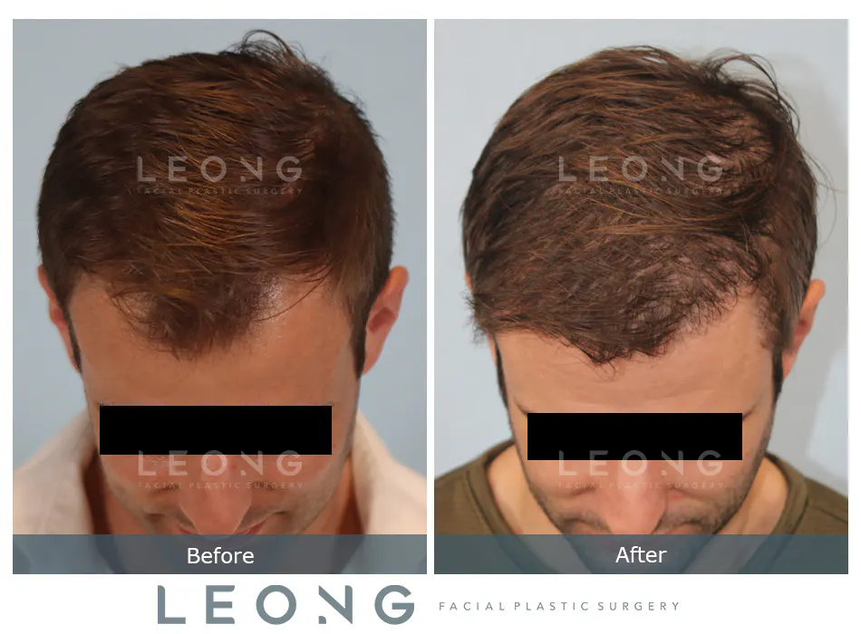 Hair Transplant Before and After | Leong Facial Plastic Surgery