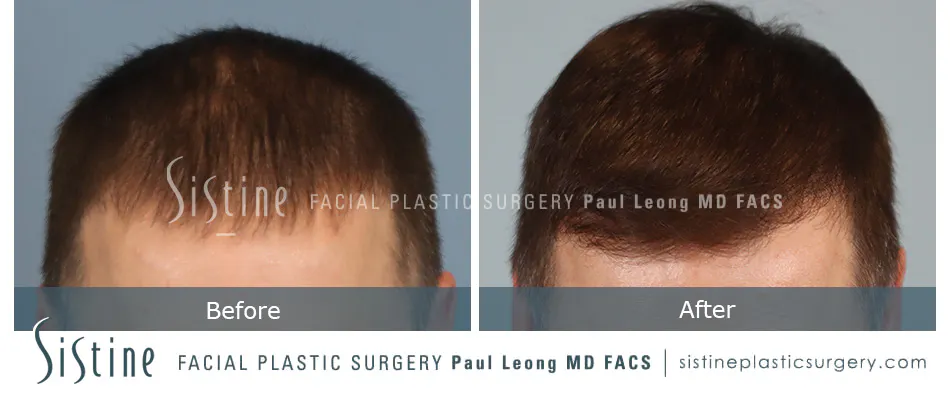 Hair Transplant Before and After | Leong Facial Plastic Surgery