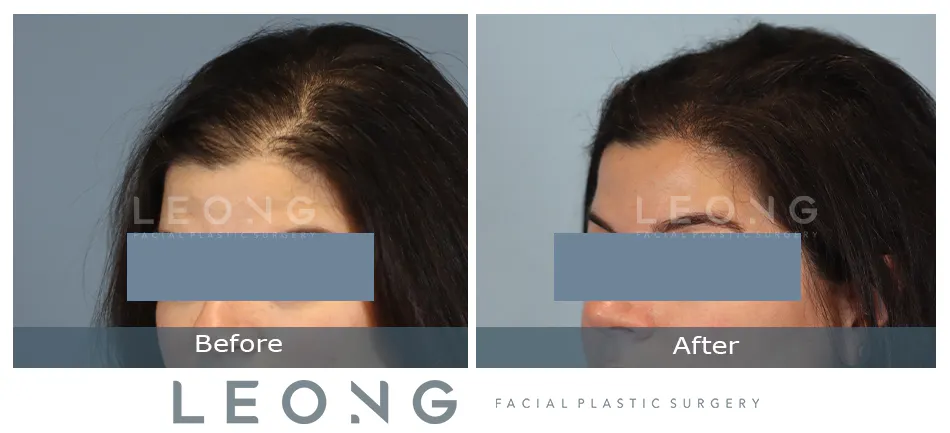 Hair Transplant Before and After | Leong Facial Plastic Surgery