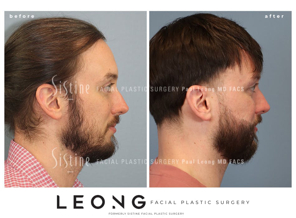 Hair Transplant Before and After | Leong Facial Plastic Surgery