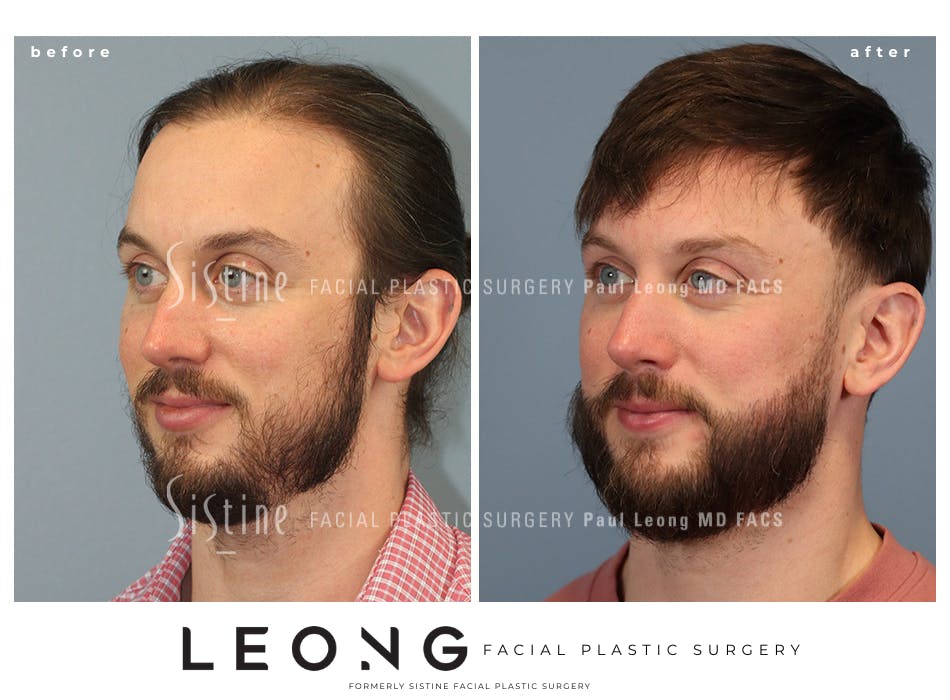 Hair Transplant Before and After | Leong Facial Plastic Surgery