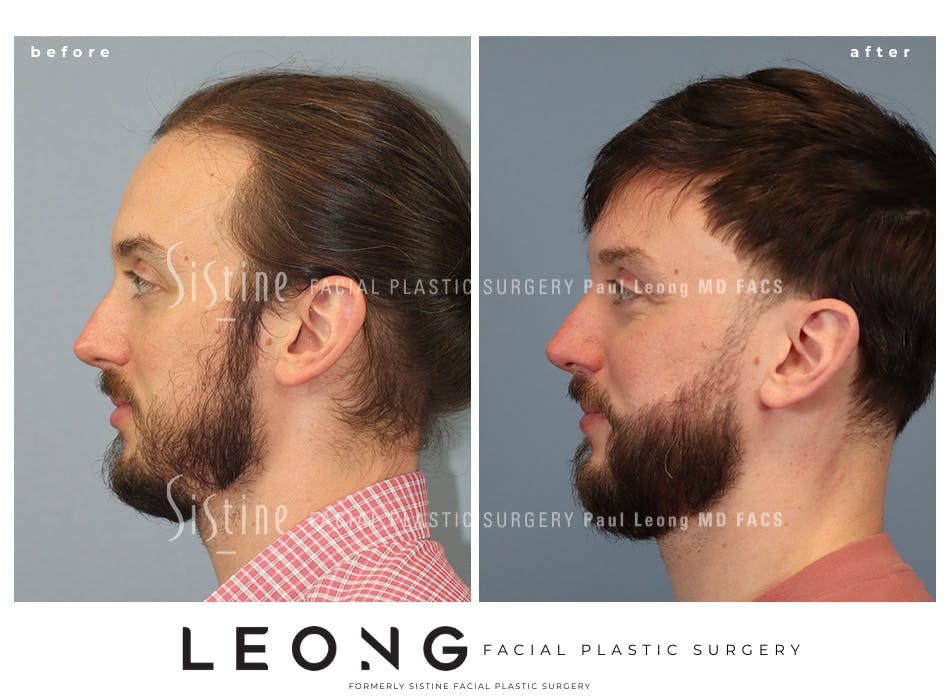 Hair Transplant Before and After | Leong Facial Plastic Surgery
