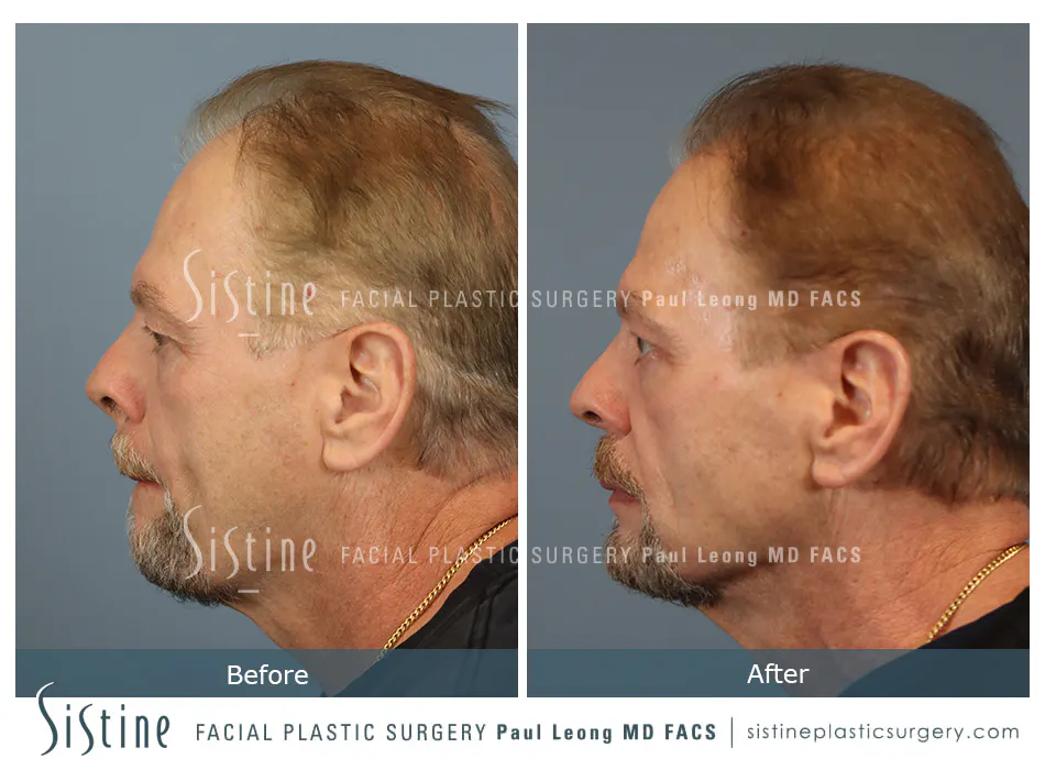 Hair Transplant Before and After | Leong Facial Plastic Surgery