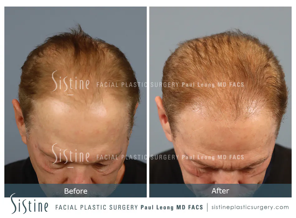 Hair Transplant Before and After | Leong Facial Plastic Surgery