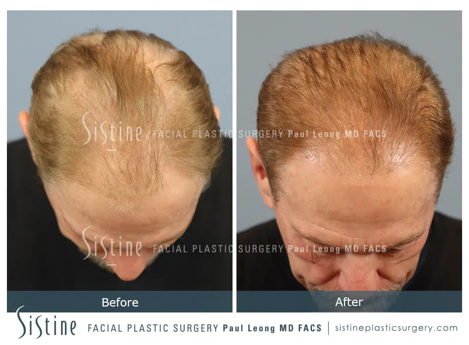 Hair Transplant Before and After | Leong Facial Plastic Surgery