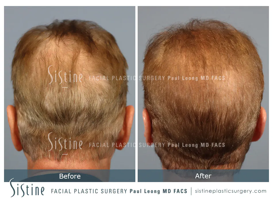 Hair Transplant Before and After | Leong Facial Plastic Surgery