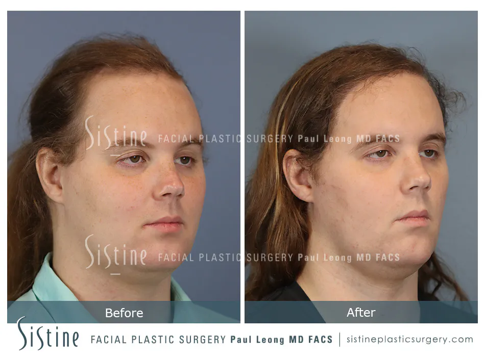 Hair Transplant Before and After | Leong Facial Plastic Surgery