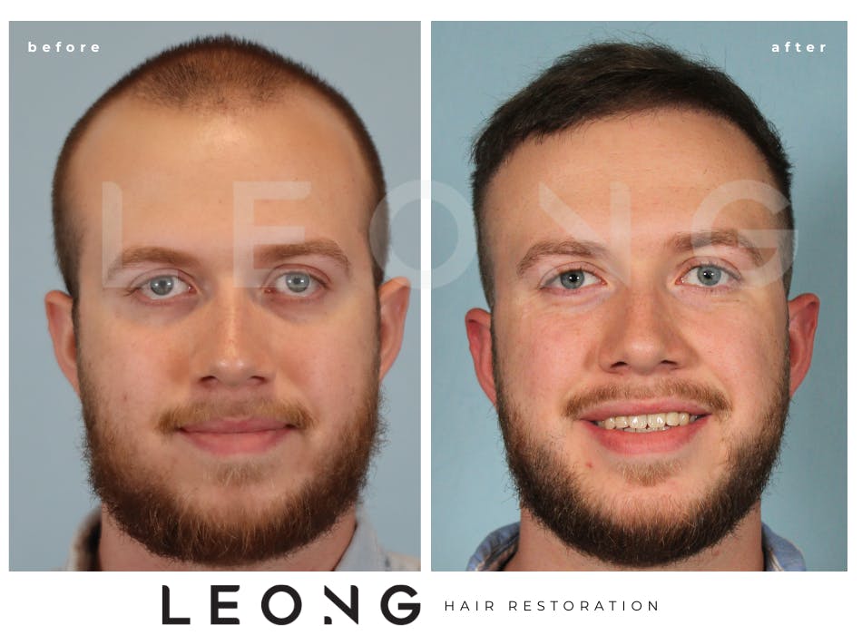Hair Transplant Before and After | Leong Facial Plastic Surgery