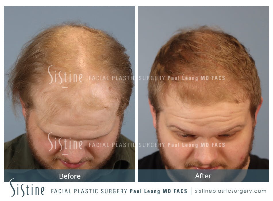 Hair Transplant Before and After | Leong Facial Plastic Surgery