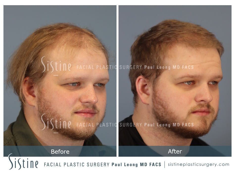 Hair Transplant Before and After | Leong Facial Plastic Surgery
