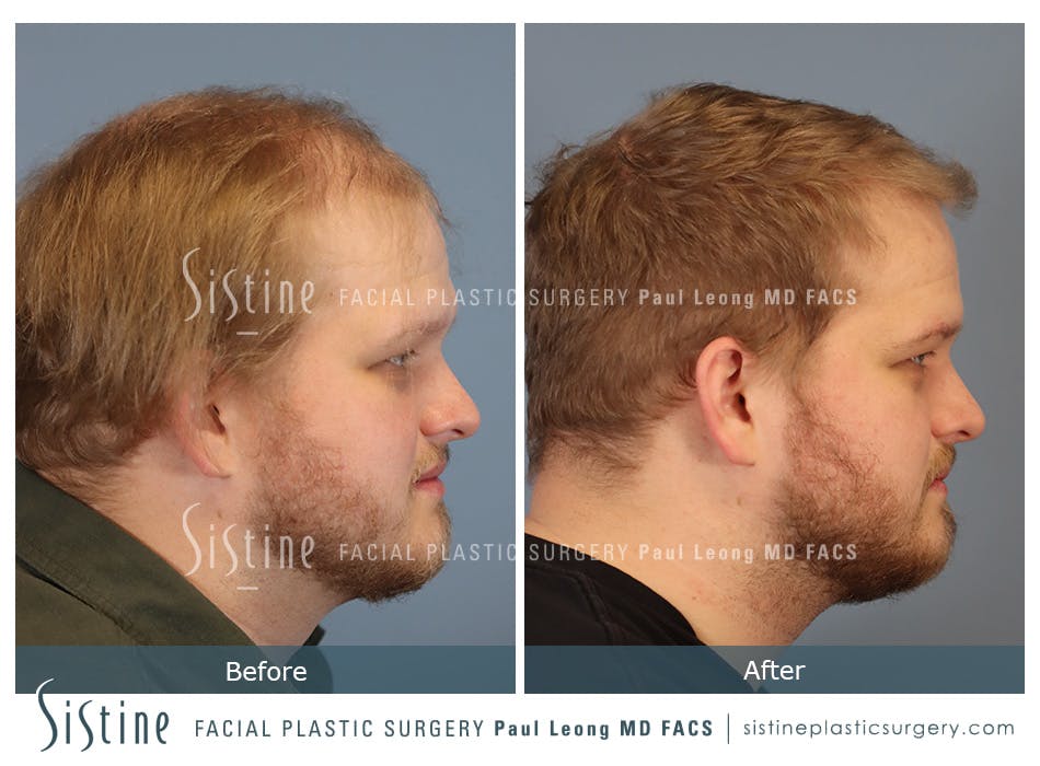 Hair Transplant Before and After | Leong Facial Plastic Surgery