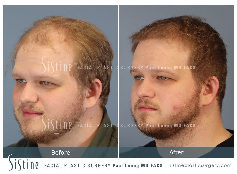 Hair Transplant Before and After | Leong Facial Plastic Surgery