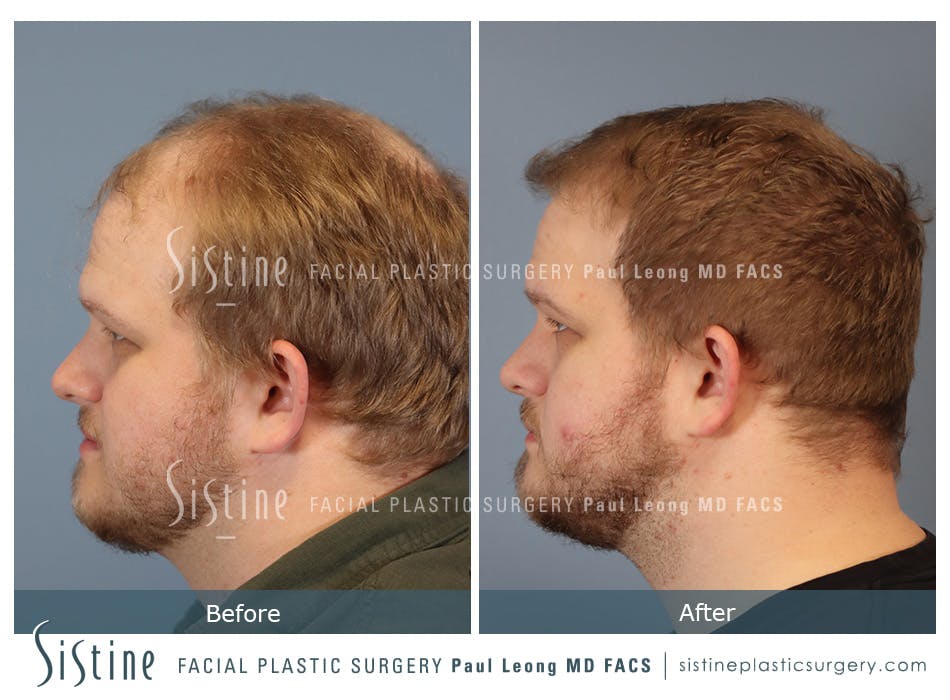 Hair Transplant Before and After | Leong Facial Plastic Surgery