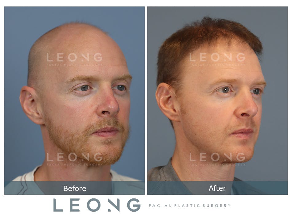 Hair Transplant Before and After | Leong Facial Plastic Surgery