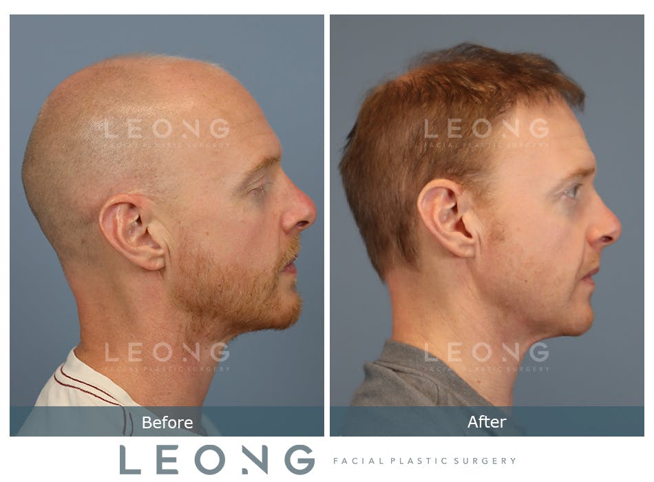 Hair Transplant Before and After | Leong Facial Plastic Surgery