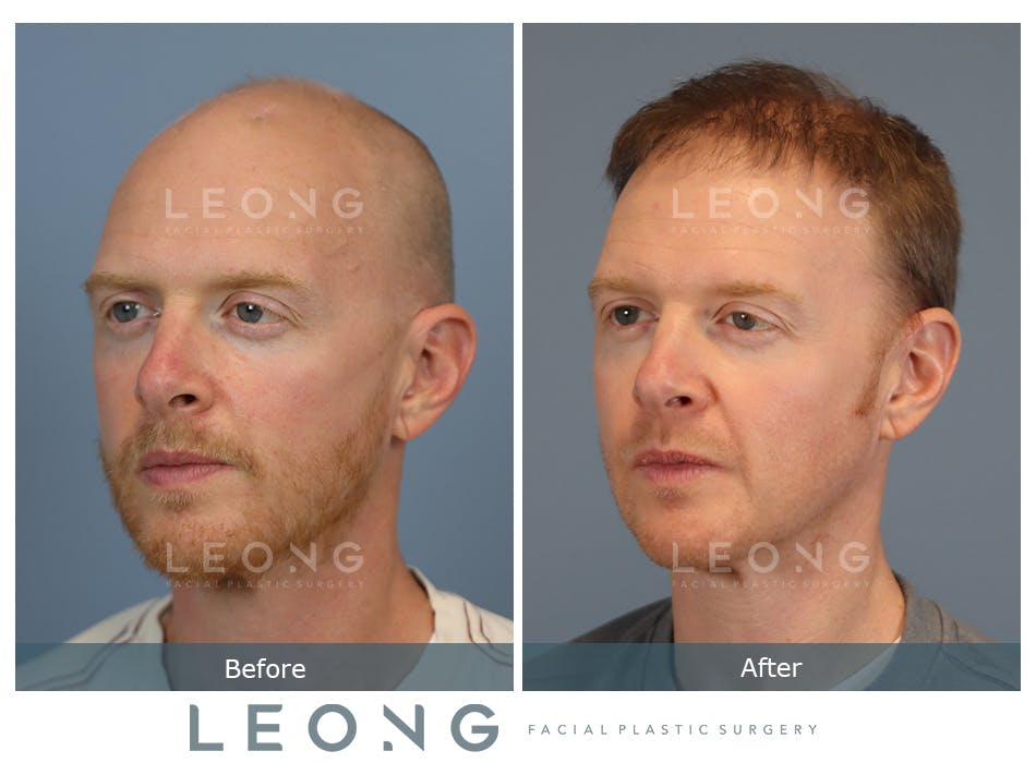 Hair Transplant Before and After | Leong Facial Plastic Surgery