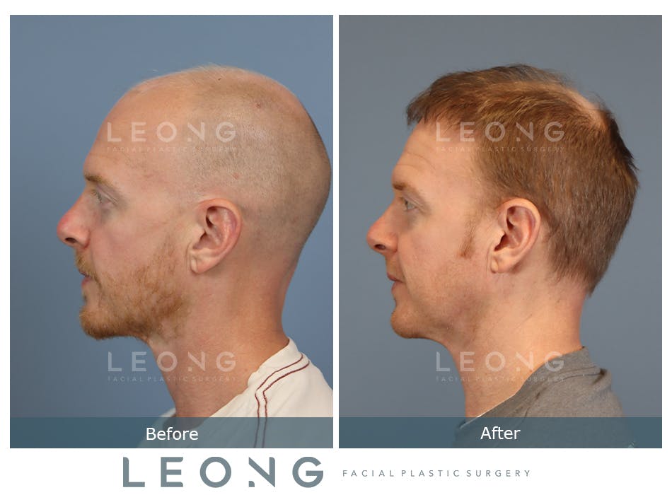 Hair Transplant Before and After | Leong Facial Plastic Surgery
