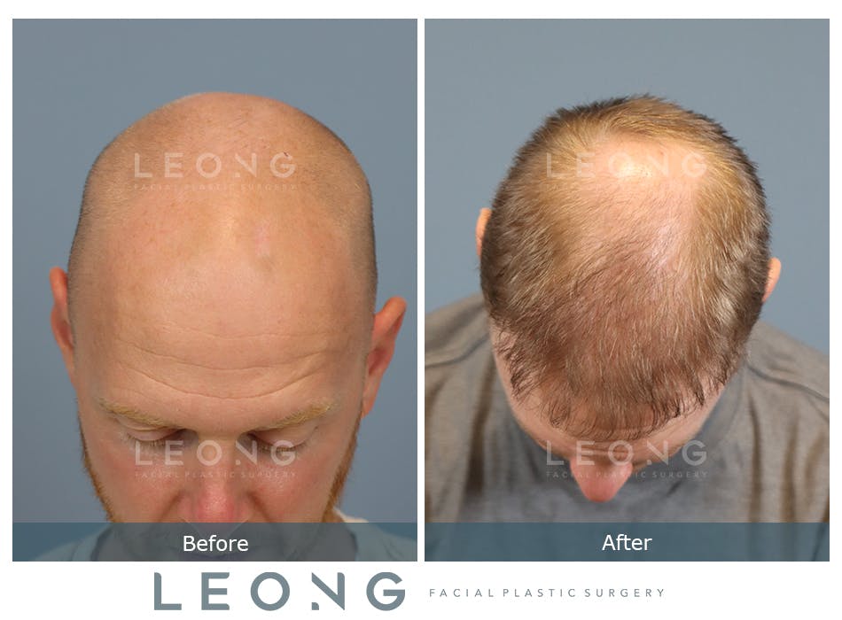 Hair Transplant Before and After | Leong Facial Plastic Surgery