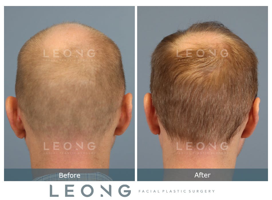 Hair Transplant Before and After | Leong Facial Plastic Surgery