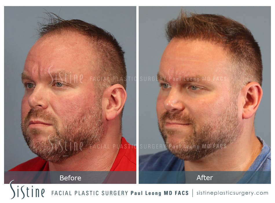 Hair Transplant Before and After | Leong Facial Plastic Surgery