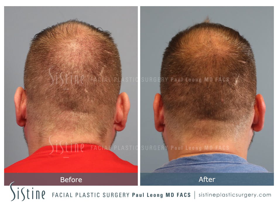 Hair Transplant Before and After | Leong Facial Plastic Surgery