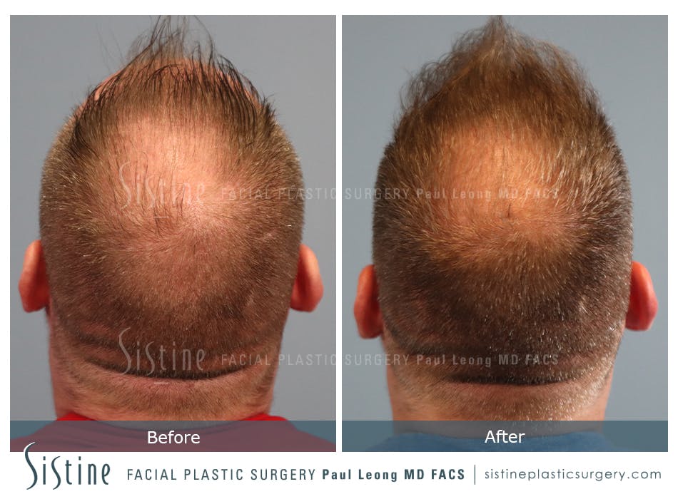 Hair Transplant Before and After | Leong Facial Plastic Surgery