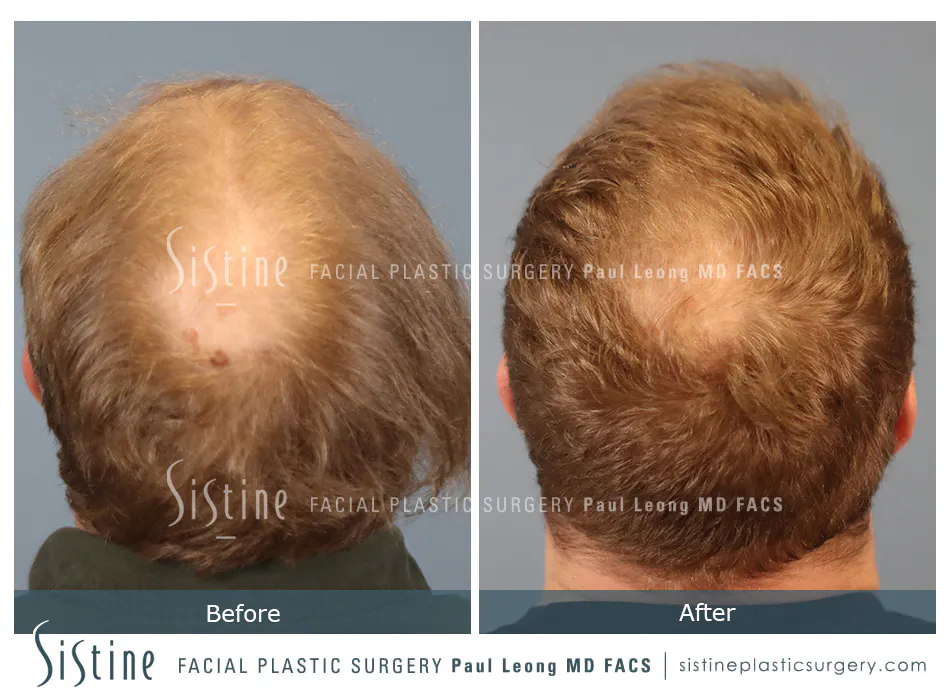 Hair Transplant Before and After | Leong Facial Plastic Surgery