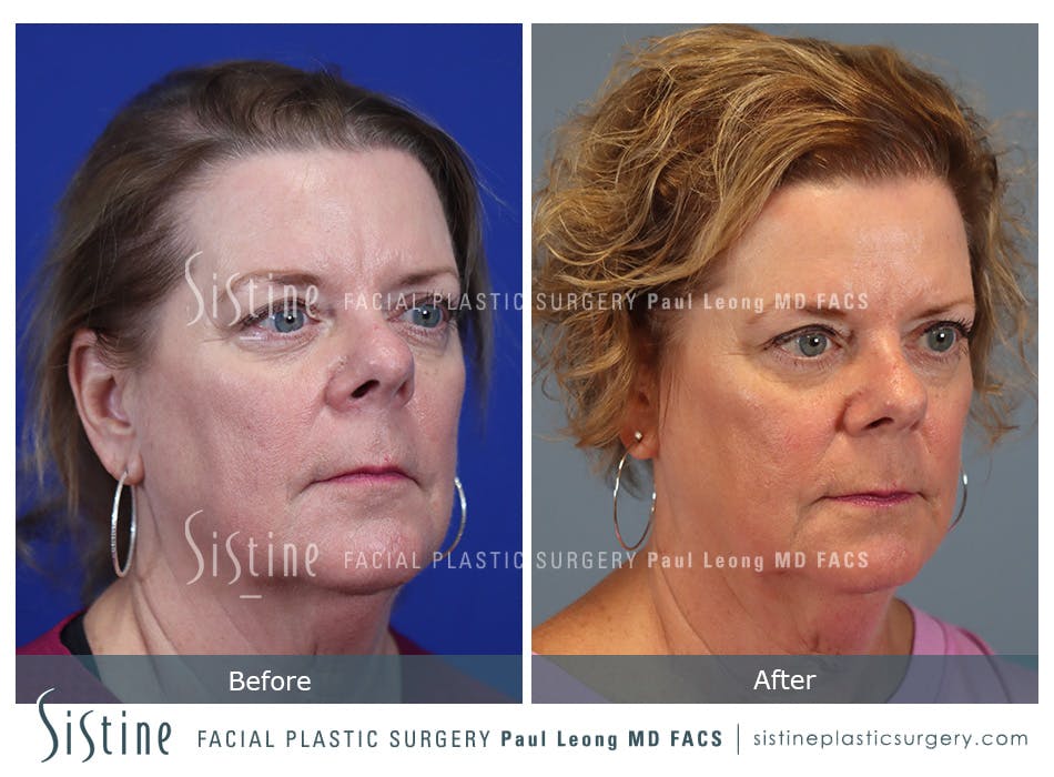 Hair Transplant Before and After | Leong Facial Plastic Surgery