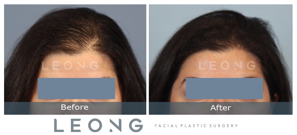 Hair Transplant Before and After | Leong Facial Plastic Surgery