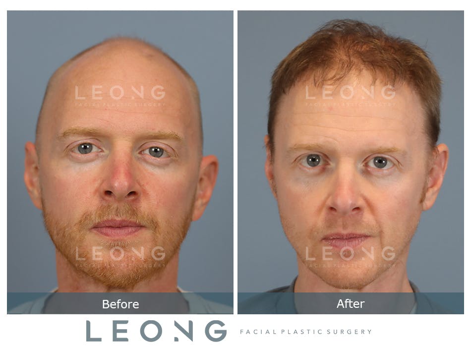 Hair Transplant Before and After | Leong Facial Plastic Surgery