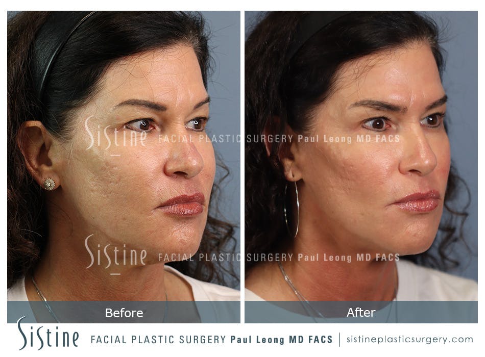 Hair Transplant Before and After | Leong Facial Plastic Surgery