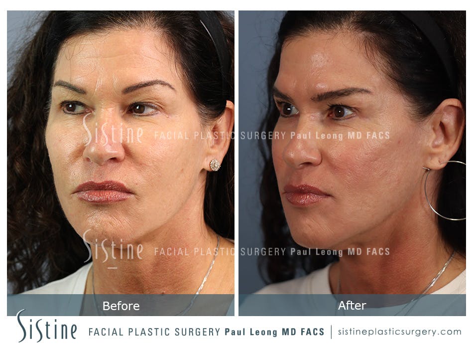 Hair Transplant Before and After | Leong Facial Plastic Surgery