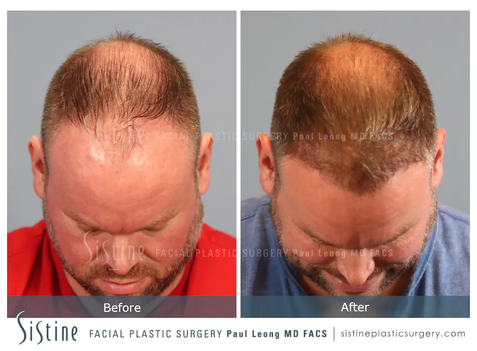 Hair Transplant Before and After | Leong Facial Plastic Surgery